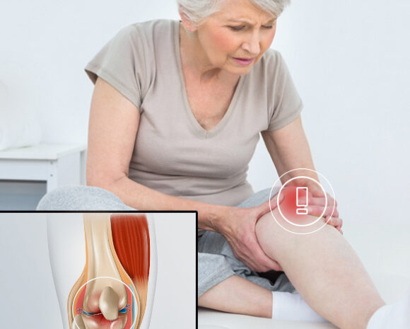 ¿Qué es la artrosis de rodilla? osteoartritis
