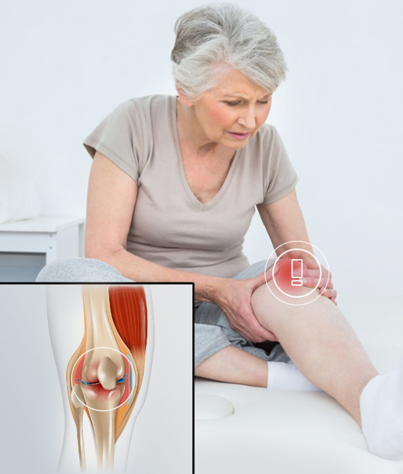 ¿Qué es la artrosis de rodilla? osteoartritis